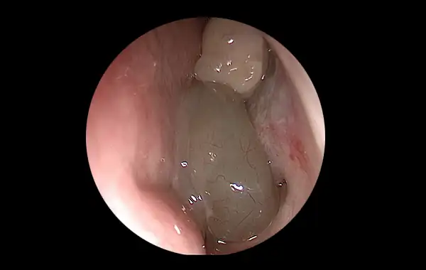 Thinnest disposable rhinoscope - Innovative medical device