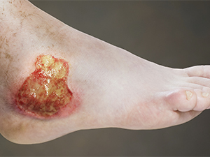 Wound-treatment boot (product code KPJ) — chronic wound treatment context; details under NDA